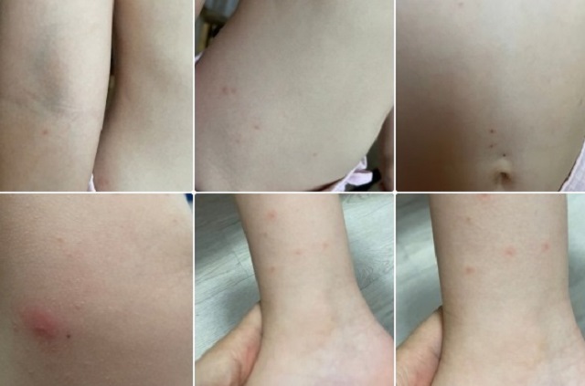 УК бездействует: блохи покусали детей в одном из домов Альметьевска