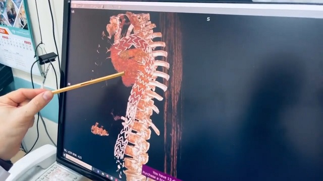 В Челнах хирурги БСМП первыми в России заменили крупнейший сосуд человека на протез