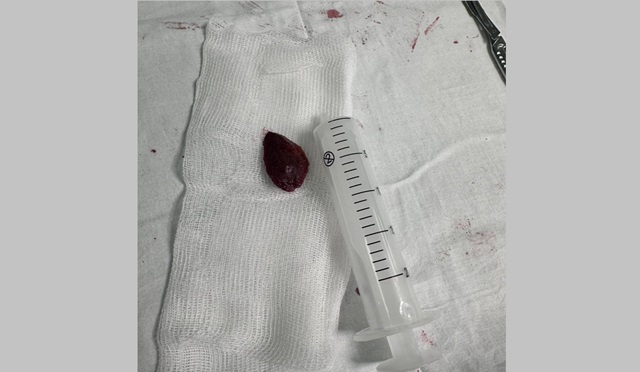 Целая кость от урюка застряла в горле жительницы Татарстана, ее спасли в РКБ