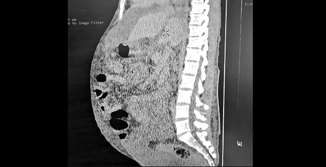 В Татарстане врачи показали критические последствия употребления алкоголя