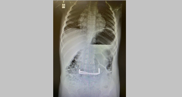 В КДМЦ Набережных Челнов спасли проглотившего 40 магнитных шариков ребенка