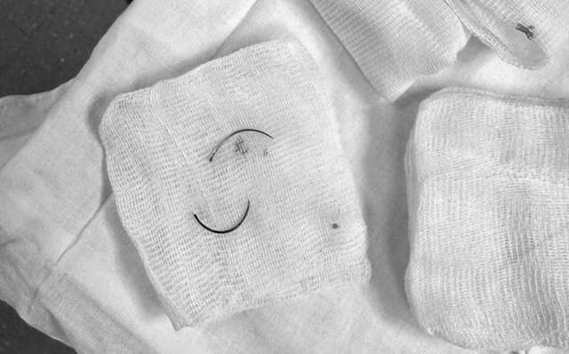 Врачи РКБ спасли пациентку, которая пять лет жила с иглами в животе 