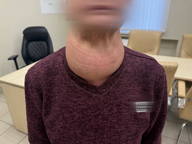 40 лет страха и один решительный врач: в РКБ удалили щитовидку размером с голову ребенка