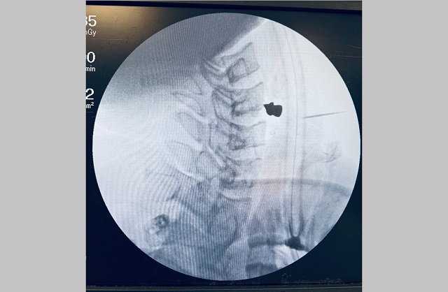 Врачи РКБ извлекли из шеи 25-летнего пациента пулю, чудом не задевшую артерии