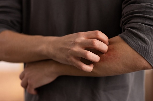 Более 7 000 татарстанцев пострадали от укусов клещей