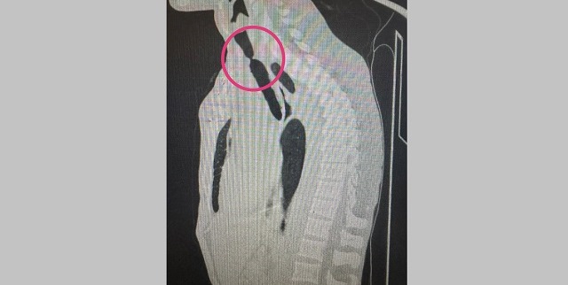 В Казани врачи РКБ впервые произвели стентирование трахеи в рубцах