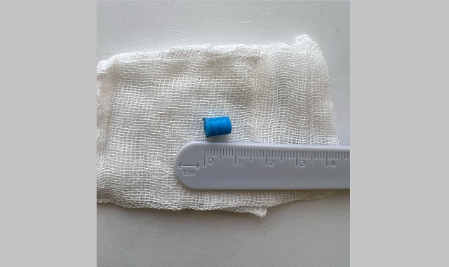 В Татарстане врачи спасли 10-летнего ребенка, случайно вдохнувшего колпачок от ручки