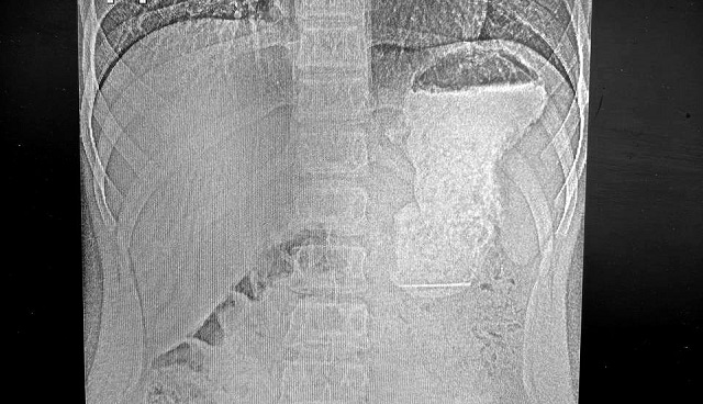 Двоих проглотивших иглы детей спасли врачи КДМЦ в Набережных Челнах