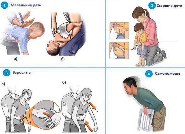 Жителям Татарстана разъяснили, как оказать помощь при асфиксии инородным телом 