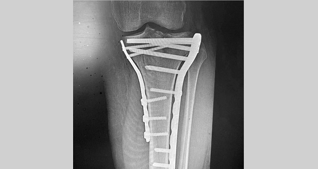 В Казани спасли мужчину, получившего многооскольчатый перелом после падения с самоката