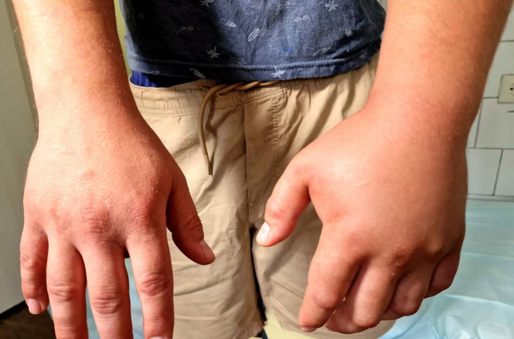 Собиравший грибы 36-летний житель Набережных Челнов попал в реанимацию после укуса гадюки