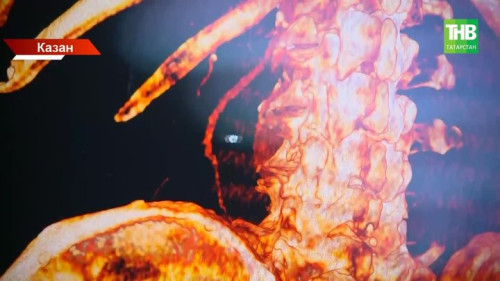 Казанда аорта аневризмасына беренче уникаль операцияләр ясалды