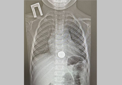 В Нижнекамске за минуту спасли малыша, проглотившего монету